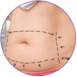 Mesotherapy for lipolysis